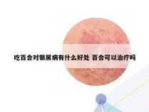 吃百合对银屑病有什么好处 百合可以治疗吗