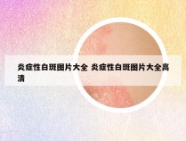 炎症性白斑图片大全 炎症性白斑图片大全高清