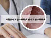 如何用中药治疗银屑病 纯中药治疗银屑病