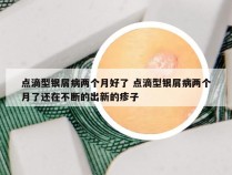 点滴型银屑病两个月好了 点滴型银屑病两个月了还在不断的出新的疹子