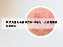 蚊子为什么会变牛皮癣 蚊子为什么会变牛皮癣的原因