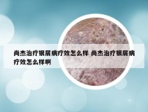 尚杰治疗银屑病疗效怎么样 尚杰治疗银屑病疗效怎么样啊