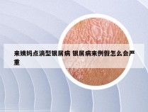 来姨妈点滴型银屑病 银屑病来例假怎么会严重