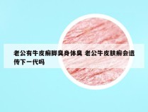 老公有牛皮癣脚臭身体臭 老公牛皮肤癣会遗传下一代吗