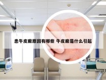 患牛皮廨原因有哪些 牛皮廨是什么引起