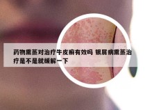 药物熏蒸对治疗牛皮癣有效吗 银屑病熏蒸治疗是不是就缓解一下