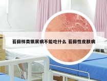 苔藓样类银屑病不能吃什么 苔藓性皮肤病
