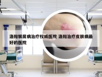 洛阳银屑病治疗权威医院 洛阳治疗皮肤病最好的医院