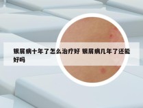银屑病十年了怎么治疗好 银屑病几年了还能好吗