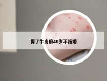 得了牛皮癣40岁不结婚