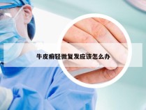 牛皮癣轻微复发应该怎么办