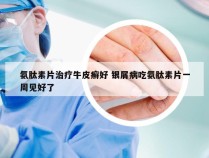 氨肽素片治疗牛皮癣好 银屑病吃氨肽素片一周见好了