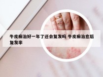 牛皮癣治好一年了还会复发吗 牛皮癣治愈后复发率