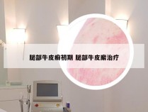 腿部牛皮癣初期 腿部牛皮廨治疗