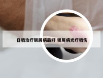 日晒治疗银屑病最好 银屑病光疗晒伤
