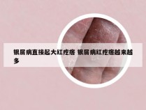 银屑病直接起大红疙瘩 银屑病红疙瘩越来越多