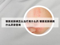 银屑皮肤病怎么治疗用什么药 银屑皮肤病用什么药膏管用