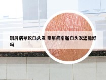 银屑病导致白头发 银屑病引起白头发还能好吗