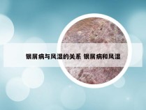 银屑病与风湿的关系 银屑病和风湿