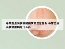 寻常型点滴状银屑病饮食注意什么 寻常型点滴状银屑病吃什么药