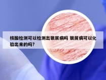 核酸检测可以检测出银屑病吗 银屑病可以化验出来的吗?