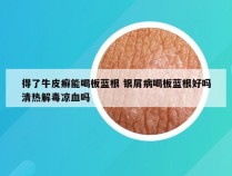 得了牛皮癣能喝板蓝根 银屑病喝板蓝根好吗清热解毒凉血吗