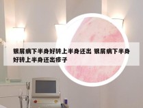银屑病下半身好转上半身还出 银屑病下半身好转上半身还出疹子