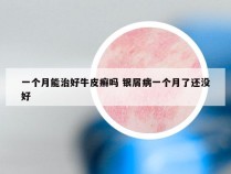 一个月能治好牛皮癣吗 银屑病一个月了还没好