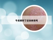 牛皮癣好了还会掉皮吗