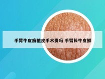 手臂牛皮癣植皮手术贵吗 手臂长牛皮鲜