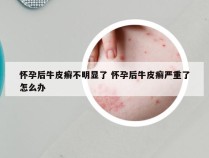怀孕后牛皮癣不明显了 怀孕后牛皮癣严重了怎么办