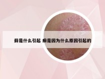 藓是什么引起 癣是因为什么原因引起的