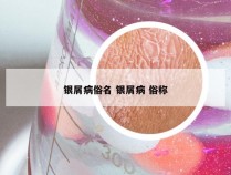 银屑病俗名 银屑病 俗称