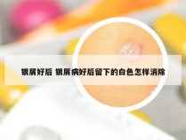 银屑好后 银屑病好后留下的白色怎样消除