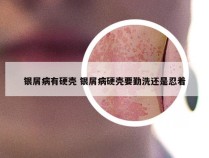银屑病有硬壳 银屑病硬壳要勤洗还是忍着