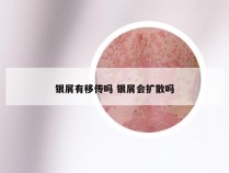 银屑有移传吗 银屑会扩散吗