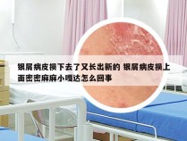 银屑病皮损下去了又长出新的 银屑病皮损上面密密麻麻小嘎达怎么回事