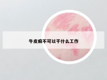 牛皮癣不可以干什么工作