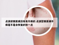 点滴状银屑病没有有不痒的 点滴型银屑病不痒是不是会恢复的快一点