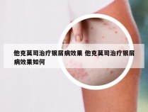 他克莫司治疗银屑病效果 他克莫司治疗银屑病效果如何