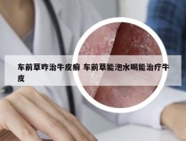 车前草咋治牛皮癣 车前草能泡水喝能治疗牛皮