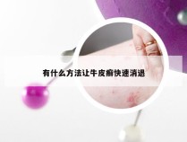 有什么方法让牛皮癣快速消退