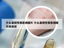 什么是假性银屑病图片 什么是假性银屑病图片和症状