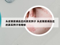 头皮银屑病自愈的真实例子 头皮银屑病自愈的真实例子有哪些