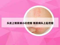 头皮上银屑病小红疙瘩 银屑病头上起疙瘩