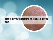 维肤灵治牛皮癣效果咋样 维肤灵可以治疗脚气吗
