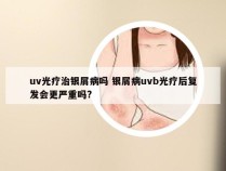 uv光疗治银屑病吗 银屑病uvb光疗后复发会更严重吗?