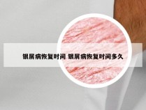 银屑病恢复时间 银屑病恢复时间多久