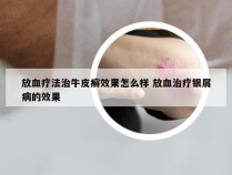 放血疗法治牛皮癣效果怎么样 放血治疗银屑病的效果