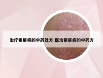 治疗银屑病的中药处方 医治银屑病的中药方